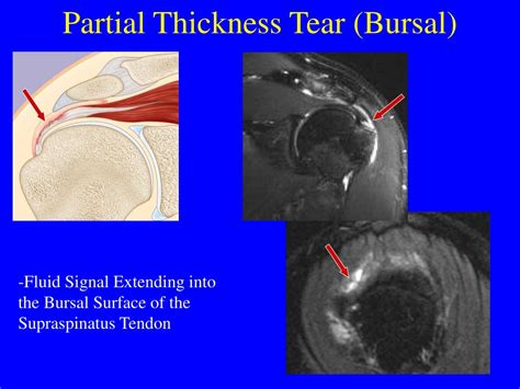 The decision for surgical treatment depends on the type of rupture,. . Bursal surface fraying treatment